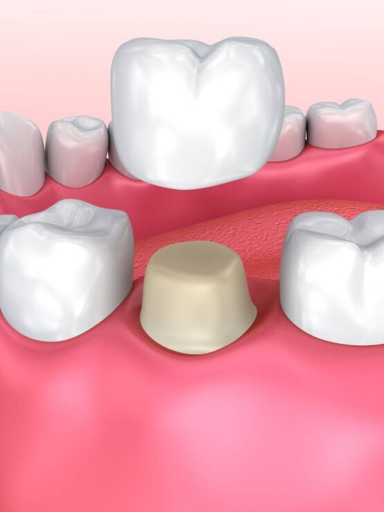 capsula dentale