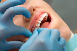 Apparecchio dentale fisso trasparente