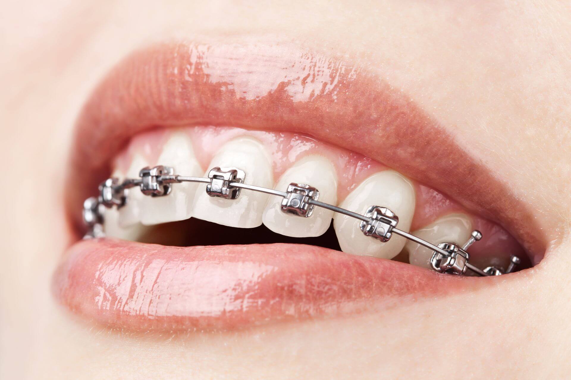 Scegliere l'apparecchio dentale classico - Dentista Como - Studio