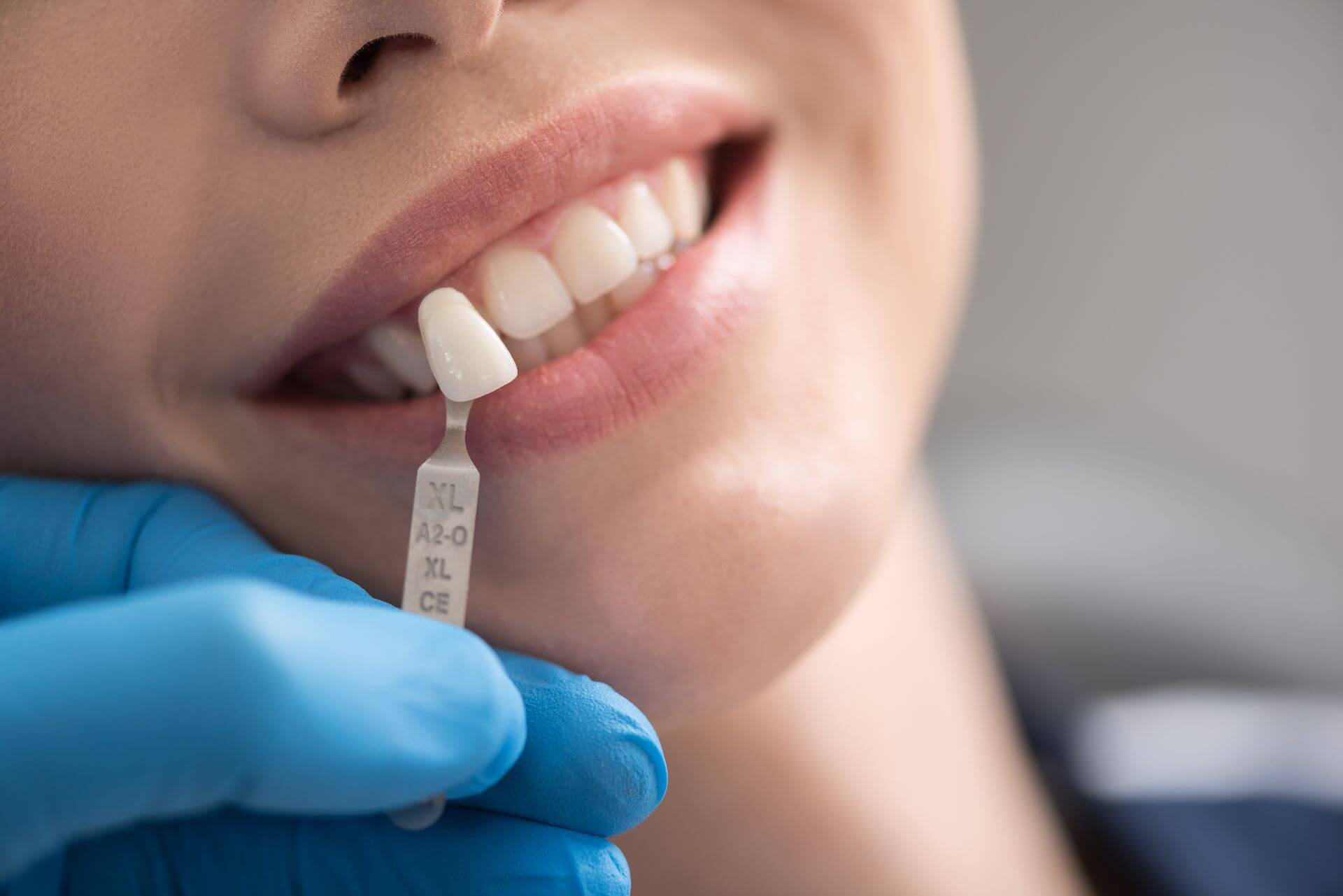 Faccette dentali in resina, porcellana e altri materiali: caratteristiche e  durata - Dentista Como - Studio Dentistico Renda