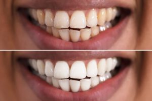 Faccette dentali prima e dopo