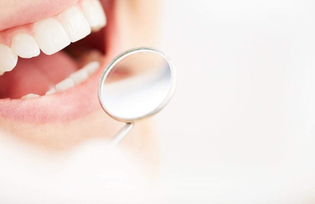 L’intervento di applicazione delle faccette ai denti