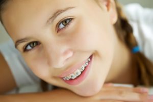 Ortodonzia linguale con o senza attacchi