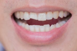 PER CHI È INDICATA L’APPLICAZIONE DI FACCETTE AI DENTI DEL TIPO LUMINEERS