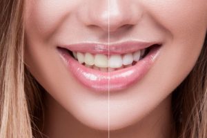 Per chi è indicato lo sbiancamento dei denti con luce blu