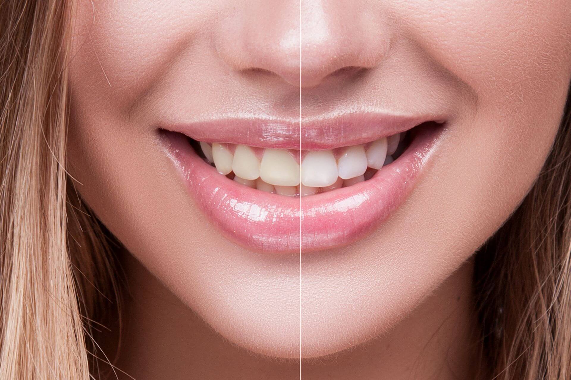 Cos'è lo sbiancamento professionale dei denti STUDIO RENDA Cos'è lo sbiancamento professionale dei denti STUDIO RENDA