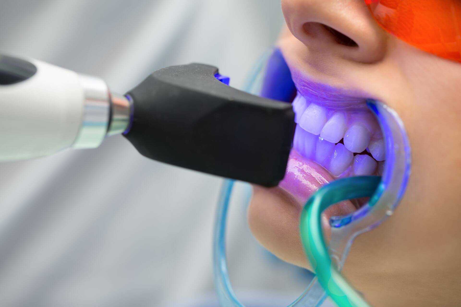 Sbiancamento professionale dei denti durata e fasi operative