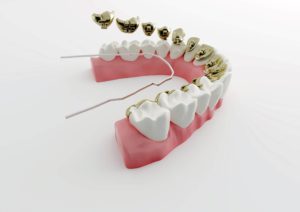 apparecchi per denti invisibili