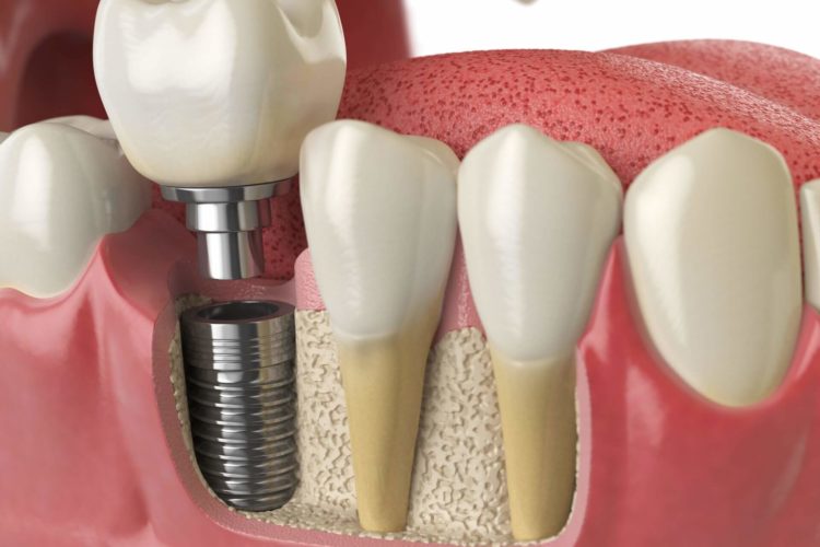 chirurgia implantare