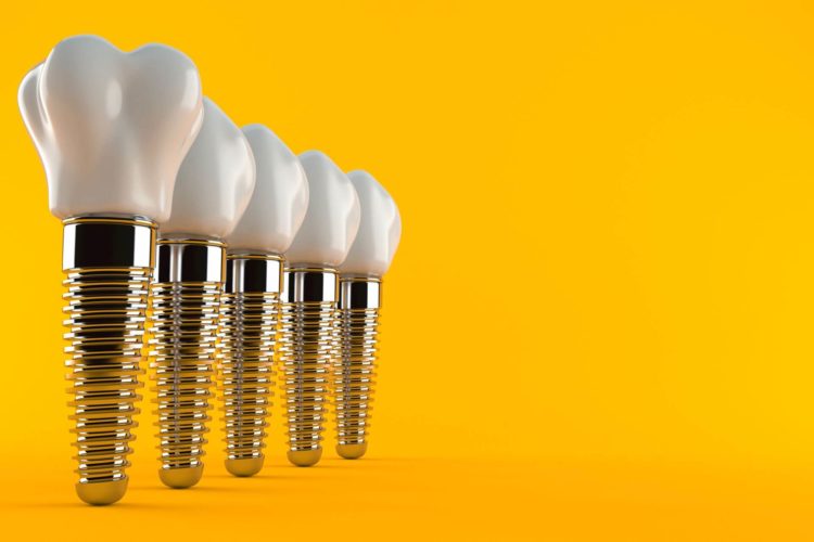 Rigetto in implantologia dentale