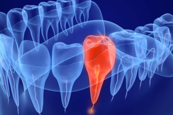 pericoli devitalizzazione denti