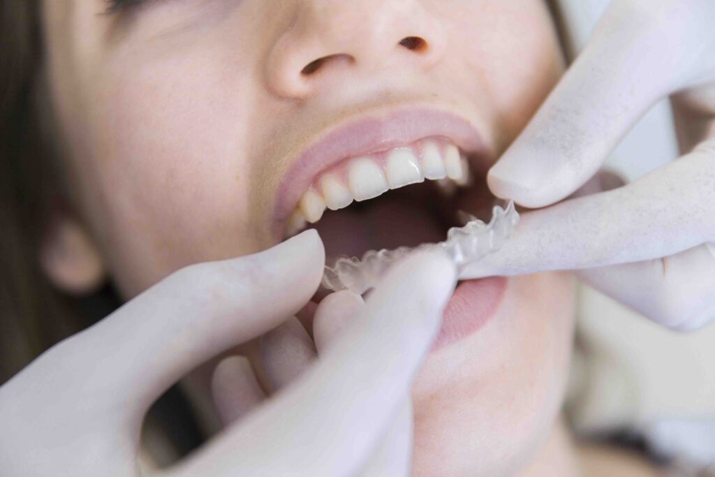 Quanto dura un trattamento con apparecchio trasparente